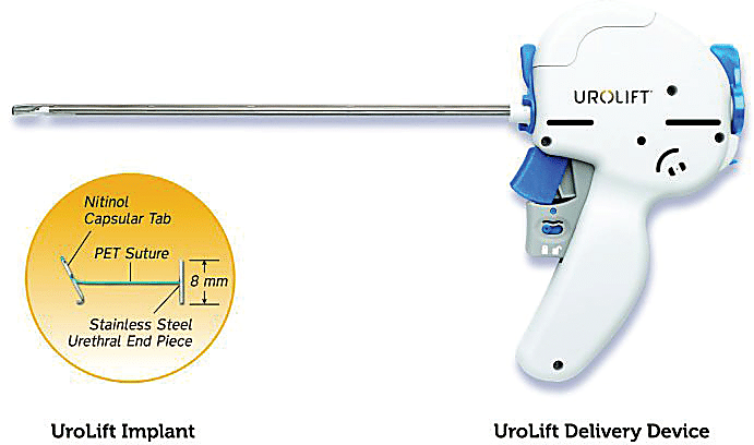 urolift-device